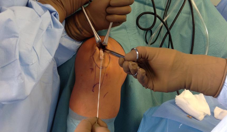 Plastika skríženého väzu BTB